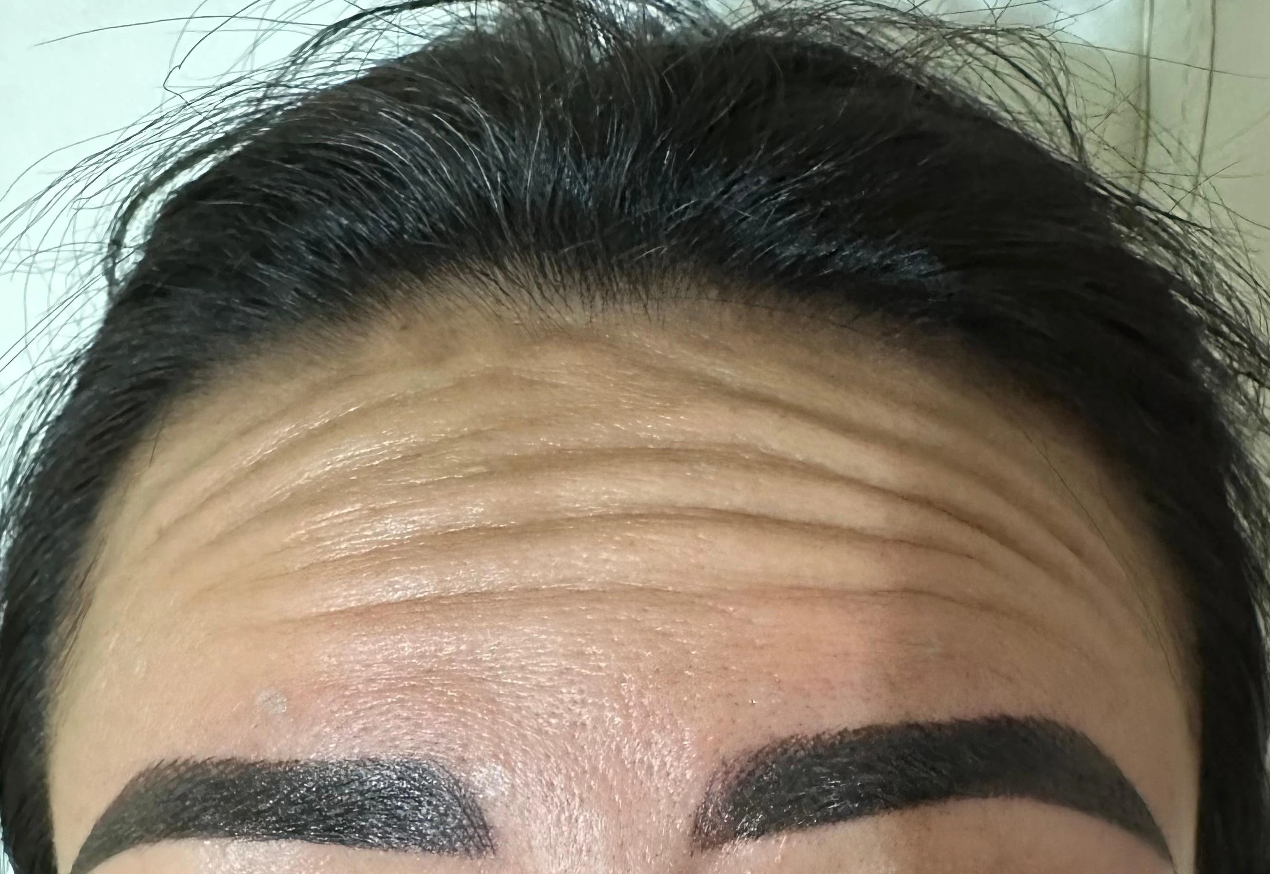 Toxina Botulínica - Antes